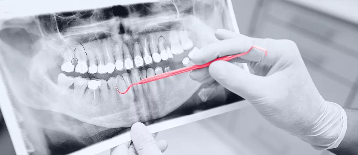 Machine Learning Algorithm for Teeth Detection