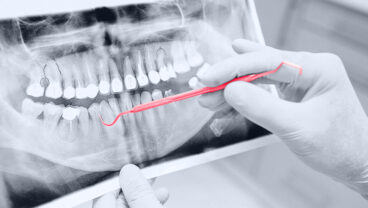 Machine Learning Algorithm for Teeth Detection