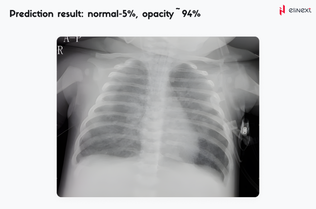 An automated pneumonia diagnosis tool